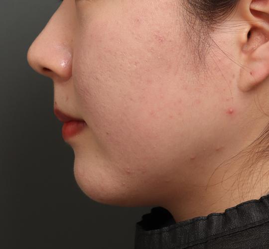 20代女性のバッカルファット除去 Before 症例写真