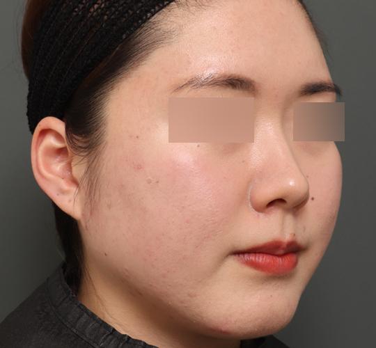 20代女性のバッカルファット除去 Before 症例写真