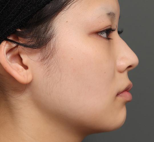 20代女性の口角挙上（スマイルリップ） After 症例写真