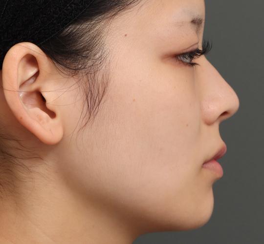 20代女性の口角挙上（スマイルリップ） Before 症例写真