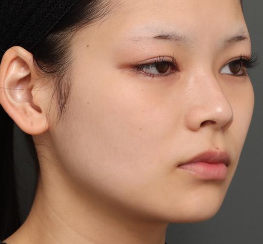 20代女性の口角挙上（スマイルリップ） Before 症例写真