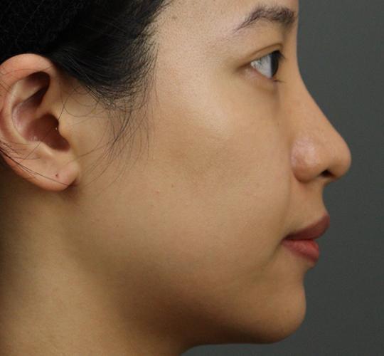 20代女性のヒアルロン酸注射  After 症例写真