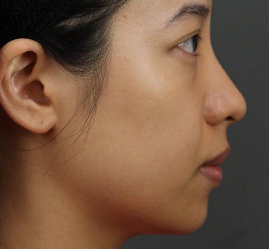 20代女性のヒアルロン酸注射  Before 症例写真