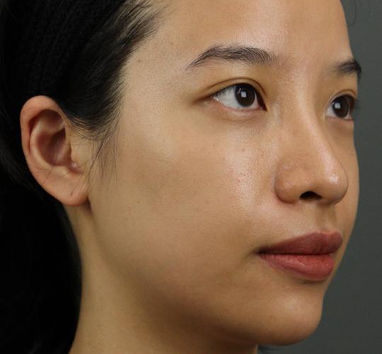 20代女性のヒアルロン酸注射  After 症例写真