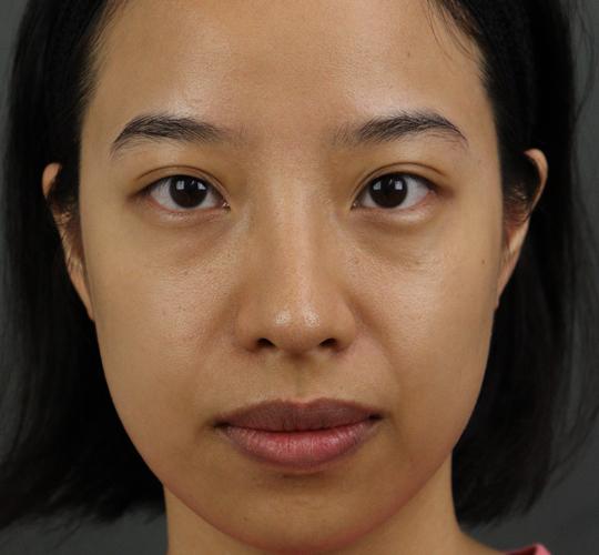 20代女性のヒアルロン酸注射 Before 症例写真