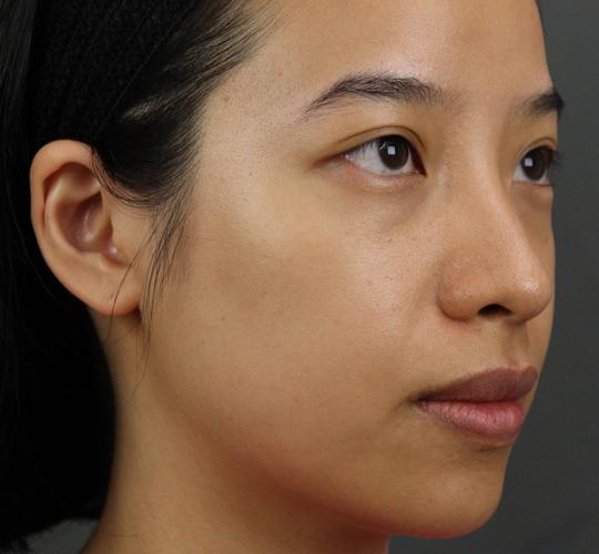 20代女性のヒアルロン酸注射  Before 症例写真