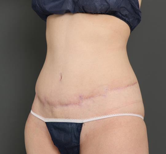 30代女性の外薗式タミータック(腹壁形成術) After 症例写真