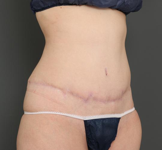 30代女性の外薗式タミータック(腹壁形成術) After 症例写真