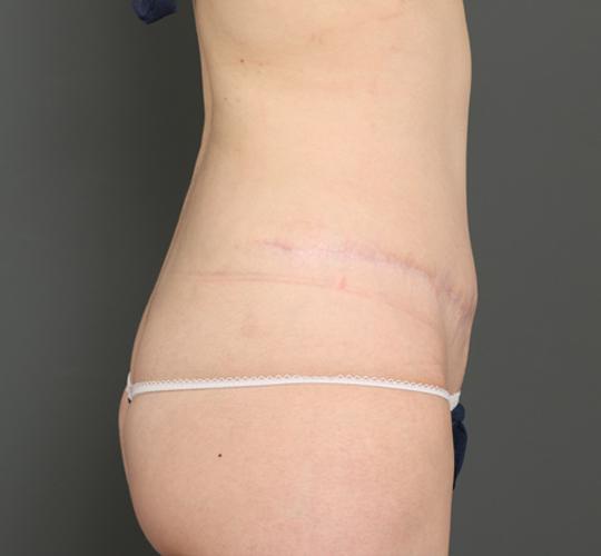 30代女性の外薗式タミータック(腹壁形成術) After 症例写真