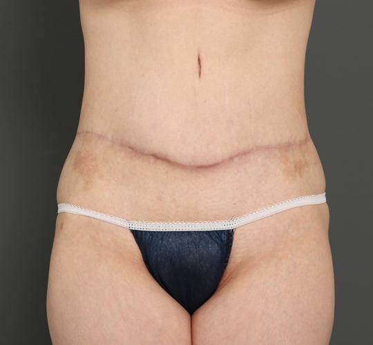 40代女性の脂肪吸引・痩身 After 症例写真