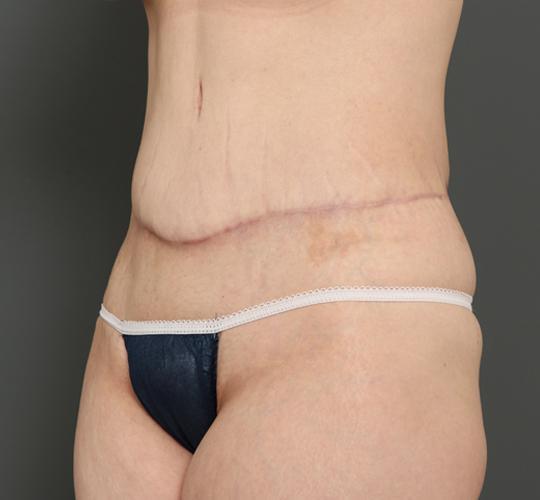 40代女性の外薗式タミータック(腹壁形成術) After 症例写真