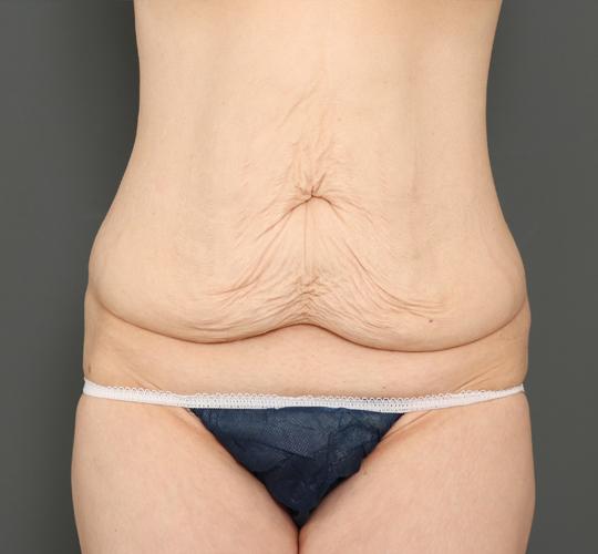 40代女性の脂肪吸引・痩身 Before 症例写真