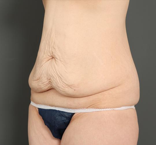 40代女性の外薗式タミータック(腹壁形成術) Before 症例写真