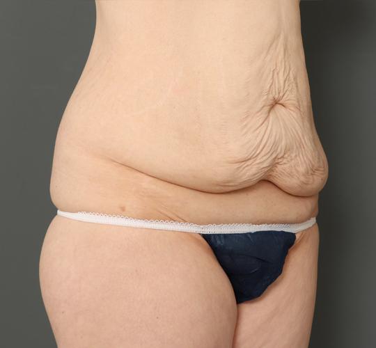 40代女性の外薗式タミータック(腹壁形成術) Before 症例写真