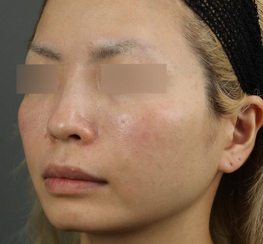 30代女性のヒアルロン酸注射(目の下) After 症例写真