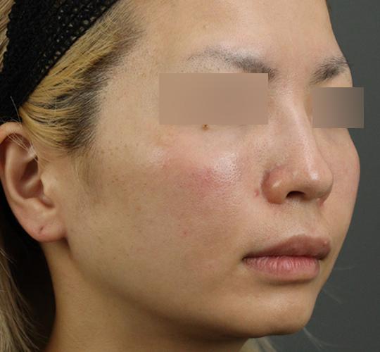 30代女性のヒアルロン酸注射(目の下) After 症例写真