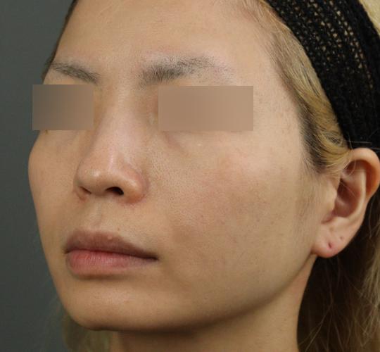 30代女性のヒアルロン酸注射(目の下) Before 症例写真