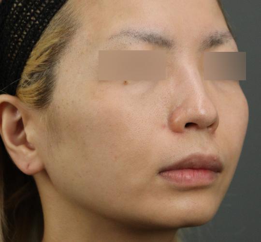 30代女性のヒアルロン酸注射(目の下) Before 症例写真