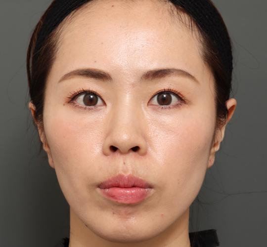 30代女性のボトックス(アゴ) After 症例写真