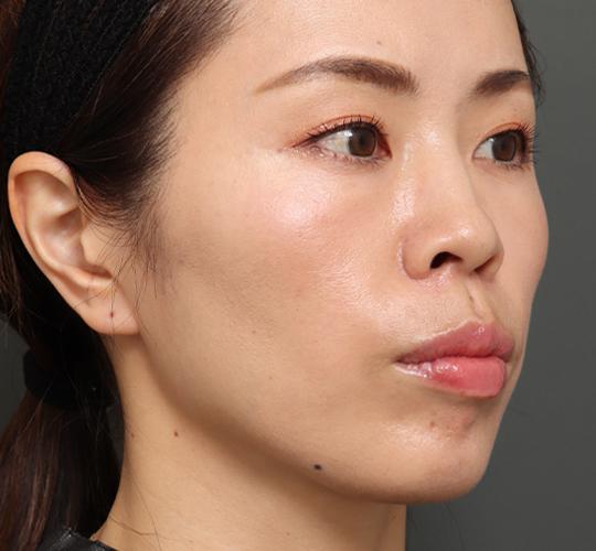 30代女性のVOVリフトプレミアム After 症例写真