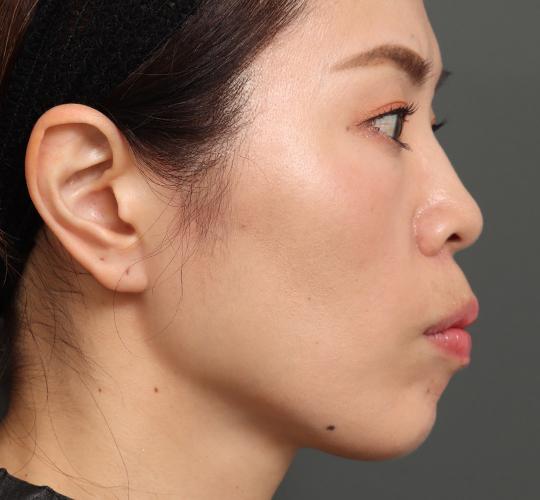 30代女性のVOVリフトプレミアム After 症例写真