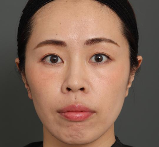 30代女性のボトックス(アゴ) Before 症例写真