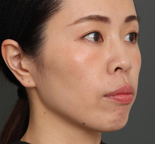 30代女性のVOVリフトプレミアム Before 症例写真