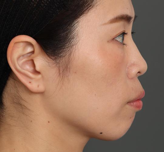 30代女性のVOVリフトプレミアム Before 症例写真