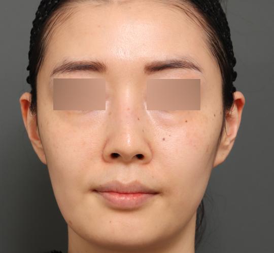 30代女性のジュべルック After 症例写真