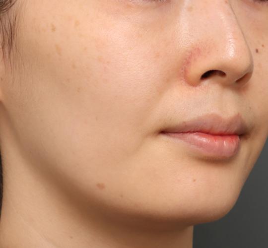 30代女性のジュべルック After 症例写真