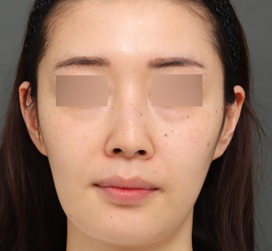 30代女性のジュべルック Before 症例写真