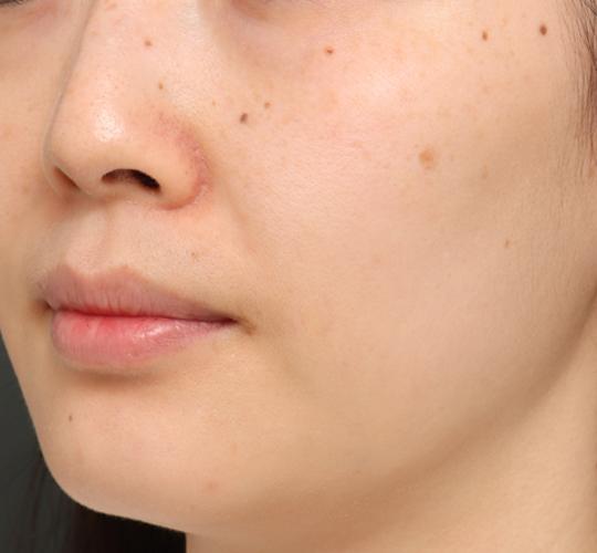 30代女性のジュべルック Before 症例写真