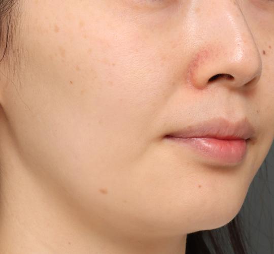 30代女性のジュべルック Before 症例写真