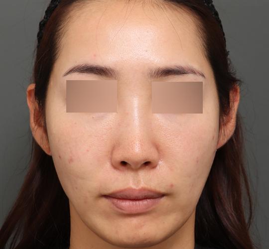 30代女性のシワ・たるみ After 症例写真