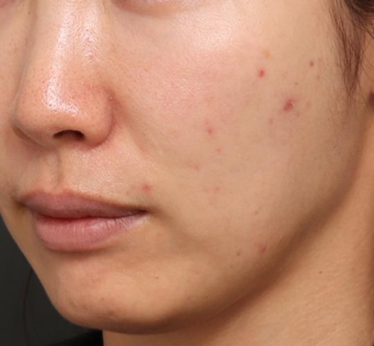 30代女性のジュべルック After 症例写真