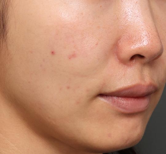 30代女性のジュべルック After 症例写真