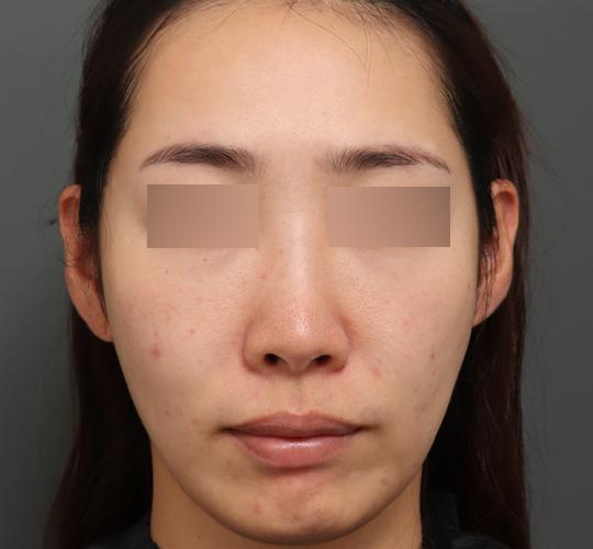 30代女性のシワ・たるみ Before 症例写真
