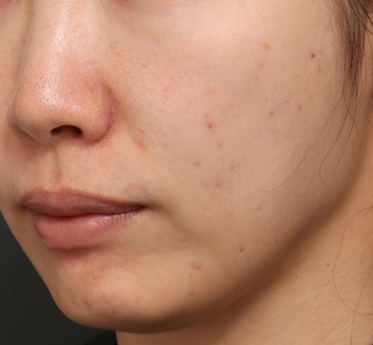 30代女性のジュべルック Before 症例写真