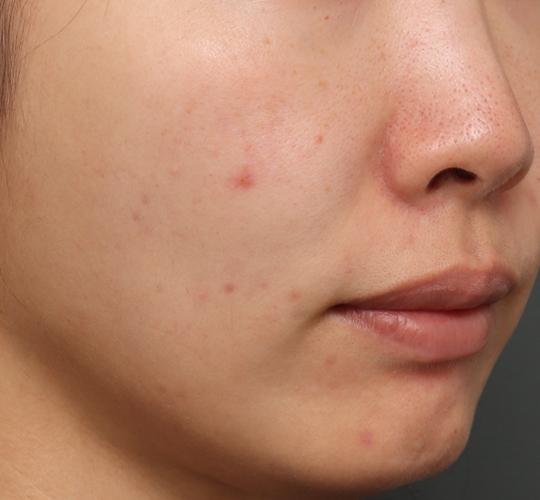 30代女性のジュべルック Before 症例写真