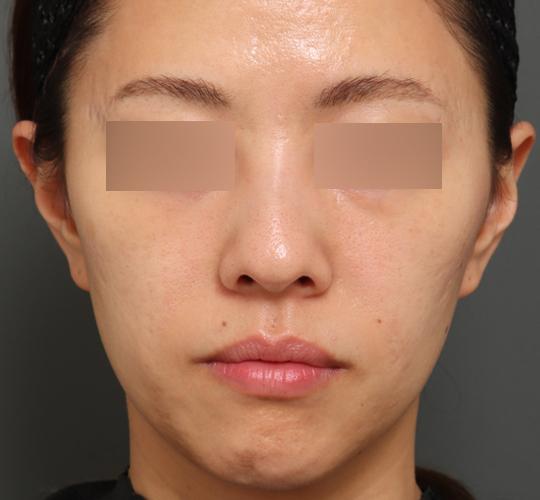 30代女性のジュべルック After 症例写真