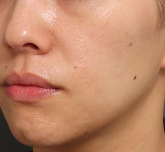 30代女性のジュべルック After 症例写真