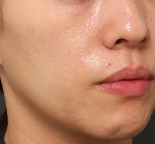 30代女性のシワ・たるみ After 症例写真