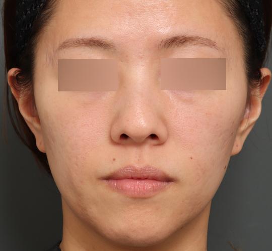 30代女性のジュべルック Before 症例写真