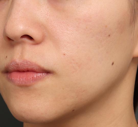 30代女性のジュべルック Before 症例写真