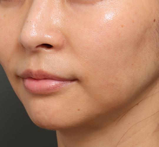 40代女性のジュべルック After 症例写真