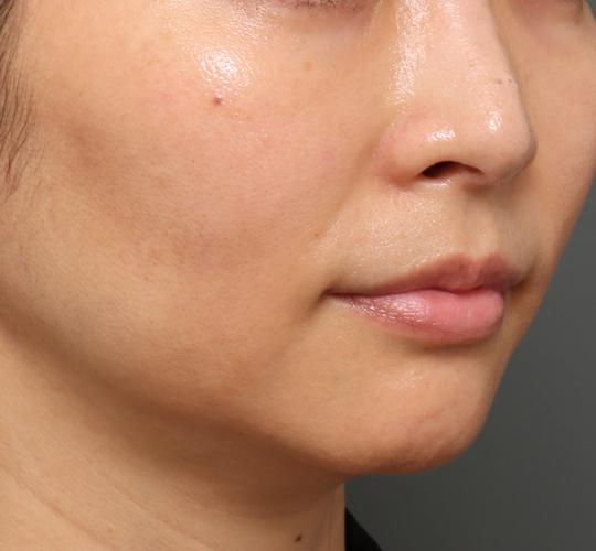 40代女性のジュべルック After 症例写真