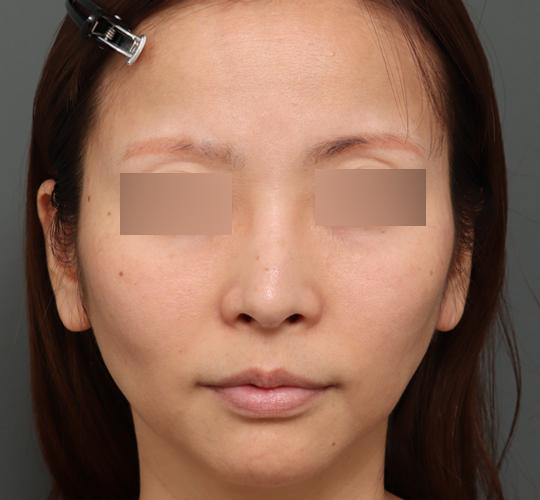 40代女性のシワ・たるみ Before 症例写真