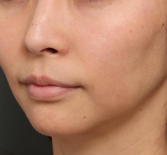 40代女性のジュべルック Before 症例写真