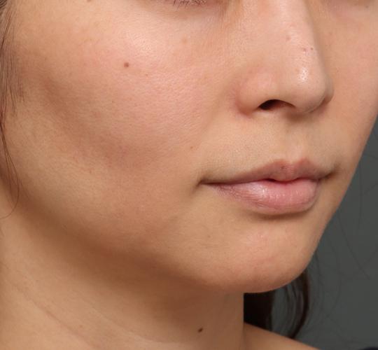 40代女性のジュべルック Before 症例写真