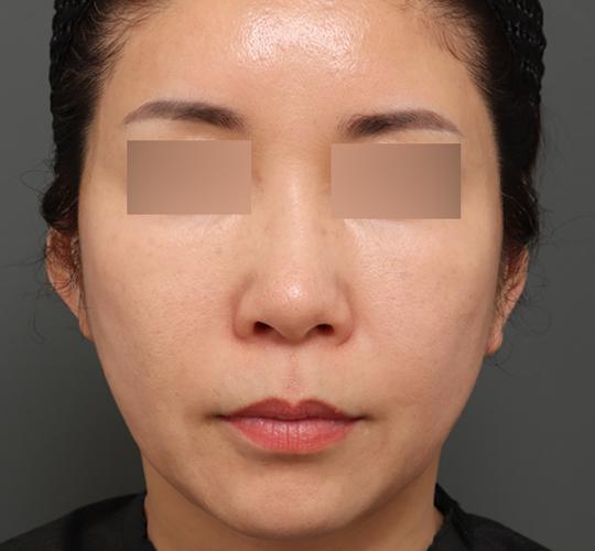 50代女性のシワ・たるみ After 症例写真